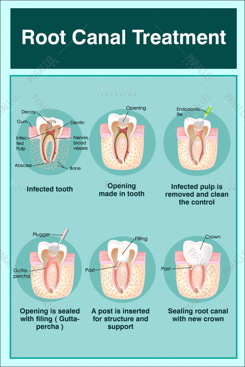 Root Canal Treatment - Parallel Learning