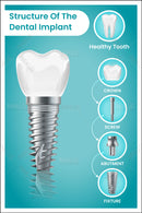 Structure Of The Dental Implant - Parallel Learning