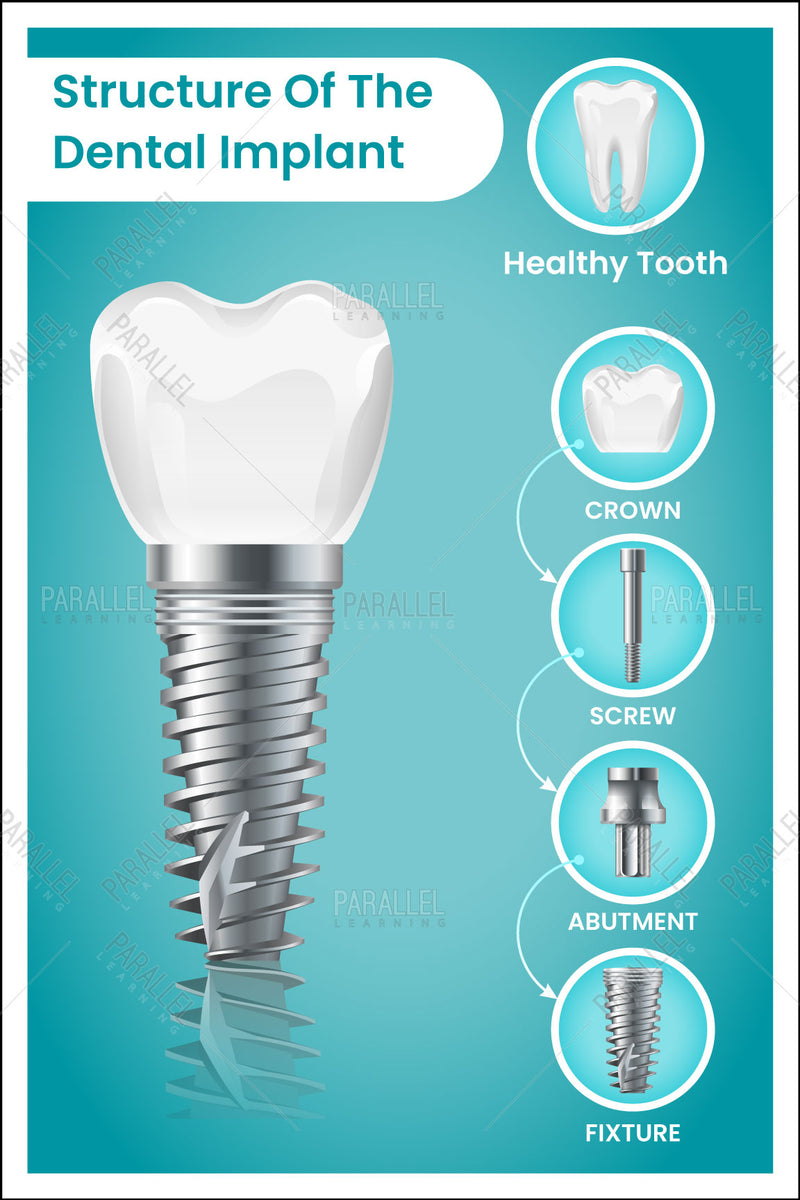 Structure Of The Dental Implant - Parallel Learning